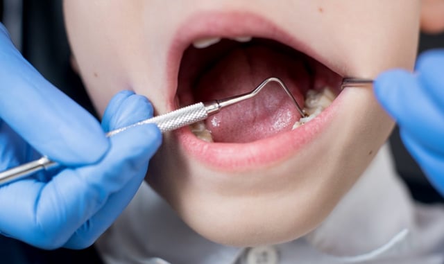 Tooth decay is also the leading cause of hospital admissions for children aged five to nine (Photo: Getty Images)