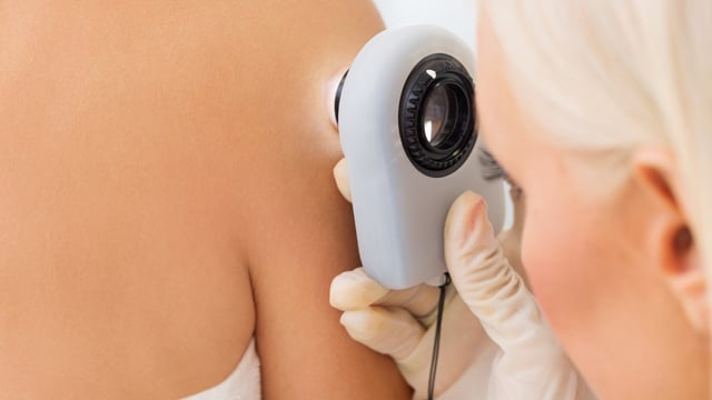 A dermatologist looking for signs of skin cancer. Melanoma is the fifth most common cancer in the UK