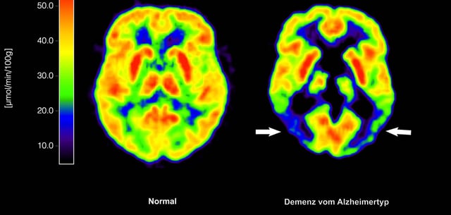 Die Tomografie zeigt die Gegenüberstellung zweier Gehirne – im gesunden Zustand und mit Alzheimer-Krankheit (r.)