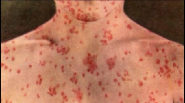Alberta Health Services has issued new warnings about at least a dozen locations in the province where people may have been exposed to confirmed cases of measles.