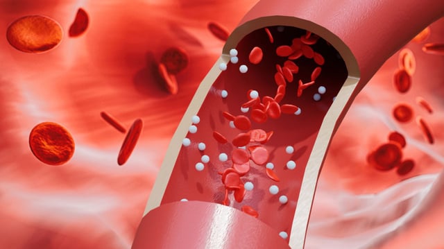 Microplastics have been detected in the blood vessels of the neck