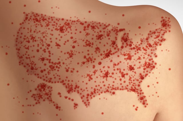 Artist&#39;s impression of measles spots forming the shape of the United States.