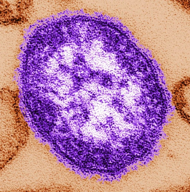 This undated image made available by the Centers for Disease Control and Prevention on Feb. 4, 2015 shows an electron microscope image of a measles virus particle. 