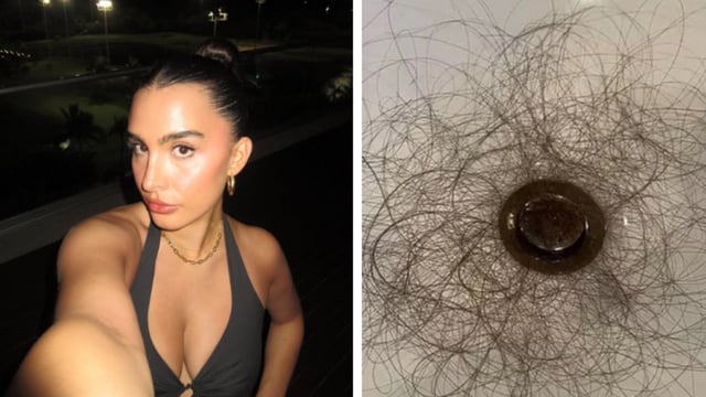 Kyle Richards' daughter, Sophia Umansky, opens up on shocking hair loss after taking a weight loss drug
