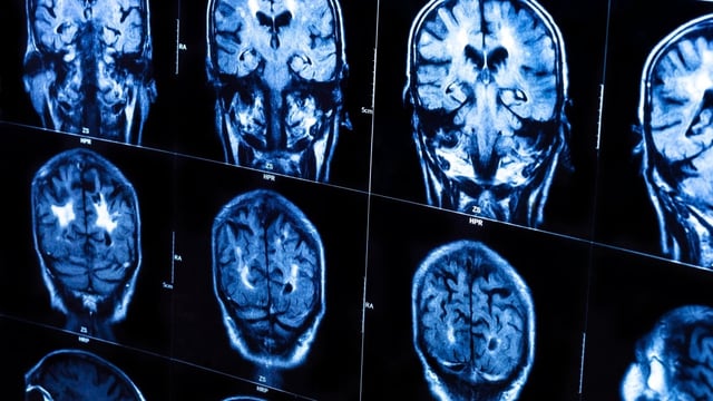 Of the 25 patients reassessed for the study, 14 are still living.