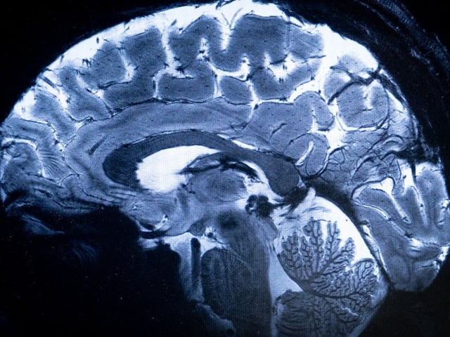 A new study published in JAMA Neurology debunks “an alleged ‘mystery’ neurological illness” that emerged in New Brunswick six years ago. 