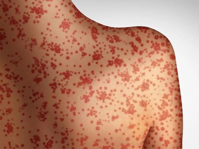 The first case of measles in Nova Scotia was confirmed on Tuesday by Public Health.