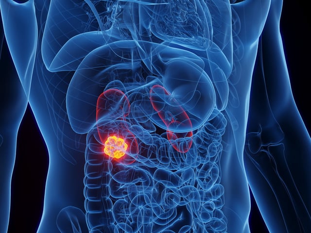 Die Illustration zeigt einen Tumor in der Niere.