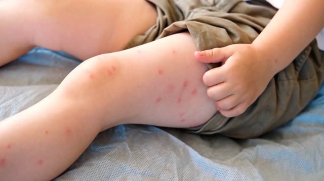 There are now more than 400 confirmed cases of measles in Alberta and the growing outbreak has health officials on both sides of the Canada-U.S. border concerned.