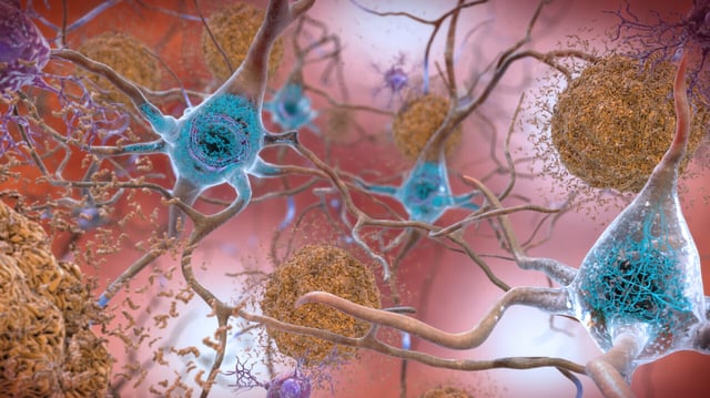 This illustration made available by the National Institute on Aging/National Institutes of Health depicts cells in an Alzheimer’s affected brain, with abnormal levels of the beta-amyloid protein clumping together to form plaques.