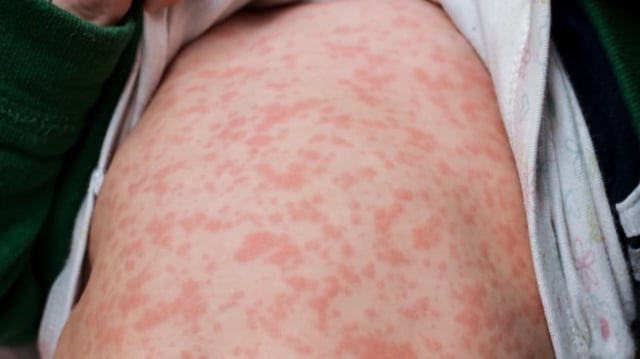 The latest numbers from Alberta Health show there were 46 new, confirmed cases of measles over the weekend with all but two of them in the province's south health zone.
