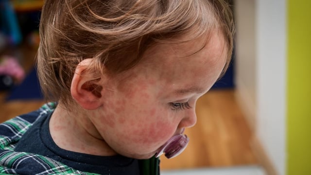A child with a measles rash. The rising number of measles cases in Canada could be part of the reason that most of the people surveyed recently by Angus Reid  agreed that childhood vaccines should be mandatory