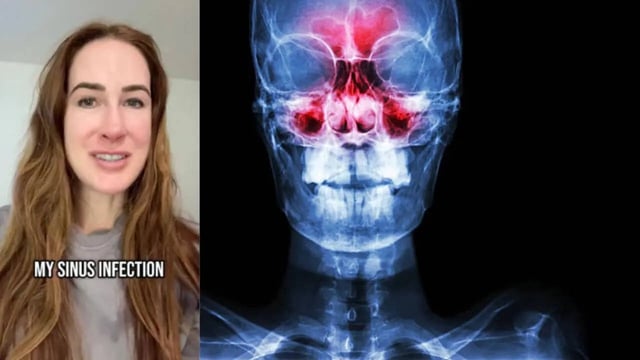 Influencer Says Boyfriend's Fart on Face Gave Her a Deadly Sinus, Know Signs and Symptoms of the Infection