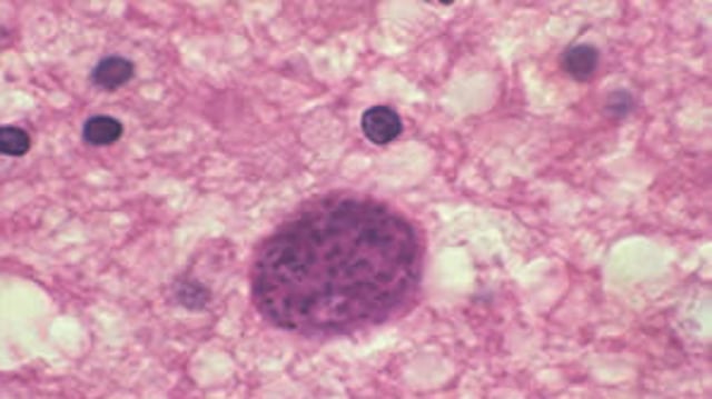 Toxoplasma gondii cyst in brain tissue. (Representative image)