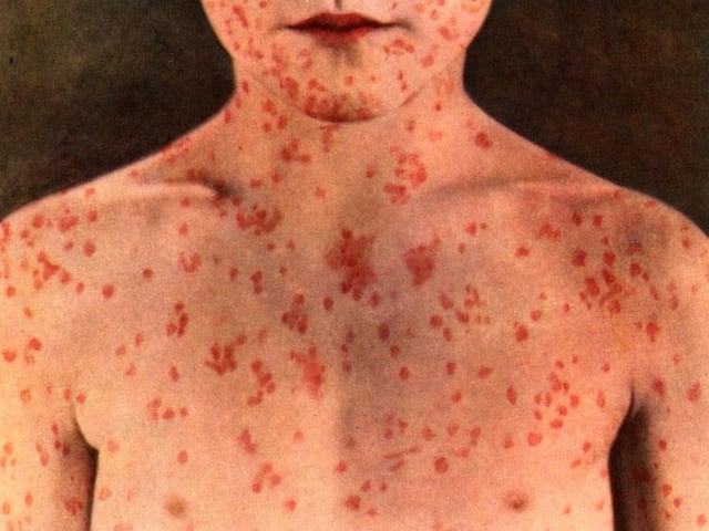 AHS warns that a person from outside Edmonton with a confirmed case of measles came to the city and was seen on May 28 between 7 p.m. and 9:45 p.m. at the foyer and information desk near the 112 Street entrance to the University of Alberta Hospital. 