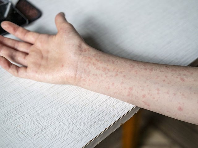 Alberta reported a total of 724 measles infections so far this year, putting the province on track to having its worst year for measles since 1986, when 843 cases were recorded.