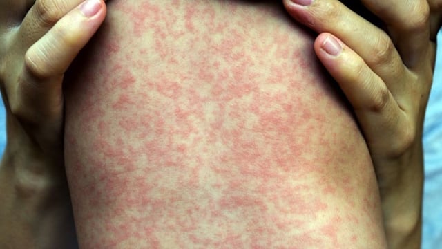 Measles symptoms can include a fever, a cough, a runny nose and red eyes, as well as a blotchy red rash. Complications can include inflammation of the brain, pneumonia and death. 