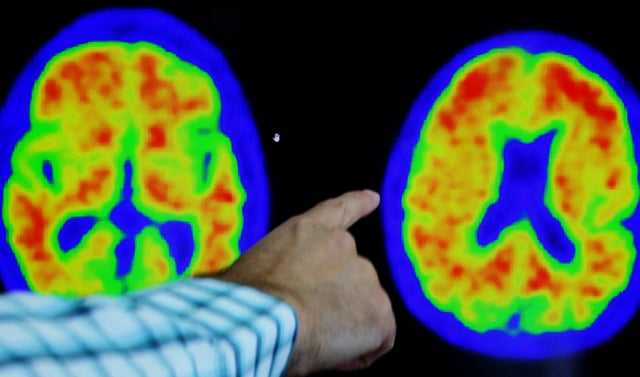 The new drug saw compelling results for those with Alzheimer&#39;s (Photo: Brian Snyder/Reuters)