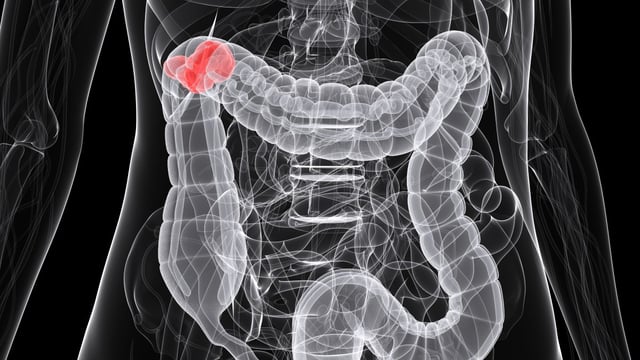 Bowel cancer cells can adapt to take on the qualities of skin cells that have much greater resilience to attack