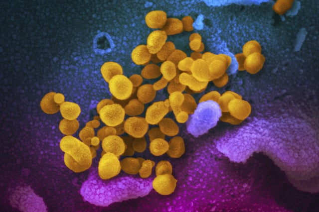 This colorized electron microscope image from the National Institutes of Health shows the SARS-CoV-2 virus, yellow, emerging from the surface of cells. A new study from UCLA researchers revealed a significant gap between physical and mental recovery from COVID-19.