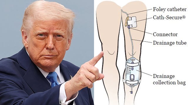 Donald Trump Catheter Theory