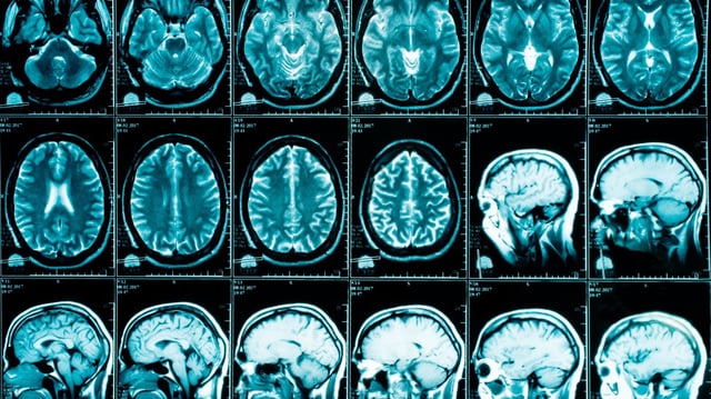 Alzheimer’s affects about 600,000 of the one million people with dementia in the UK
