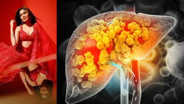 What Is Liver Cirrhosis Bigg Boss Fame Sana Makbul Has Been Diagnosed With