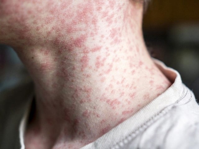 Alberta has surpassed 900 cases of measles since the beginning of March.
