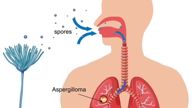 Minimising exposure to the fungus, especially in high-risk areas, can help prevent aspergillus fumigatus. (Representative picture: Freepik)