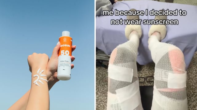 She was rushed to the hospital where doctors diagnosed her with a rare and dangerous third-degree sunburn