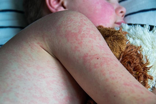 A new health alert has been issued after a confirmed case of measles has been identified in Sydney’s inner south.