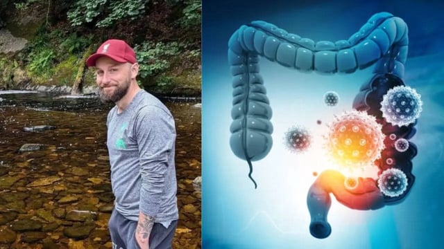 Man Dies Just Months After He Blamed Stress For His Stomachache; Got Diagnosed With Deadly Bowel Cancer