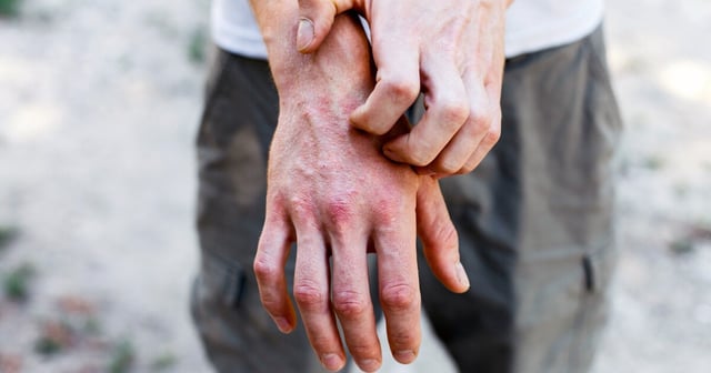 A new immunotherapy injection has provided significant relief to eczema sufferers