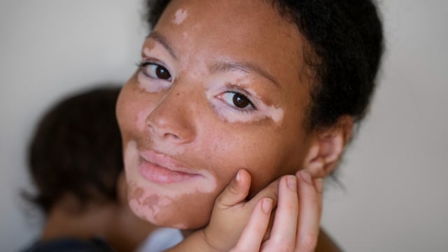 Vitiligo is a chronic skin condition in which patches of skin lose their pigment-producing cells, resulting in white or light-colored spots. (Freepik)