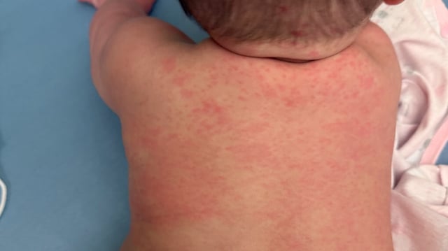 Alberta's Kimie Fukuta-Birch was just four months old when she was diagnosed with measles in spring of 2025.