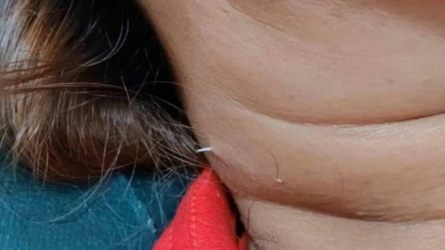 Fish Bone Pierces Through Thai Woman's Neck, Shocks Internet