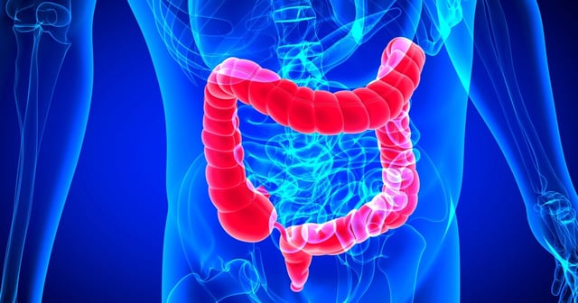 Diiverticulitis risk can be greatly reduced even if you're genetically more likely to develop it, new study finds
