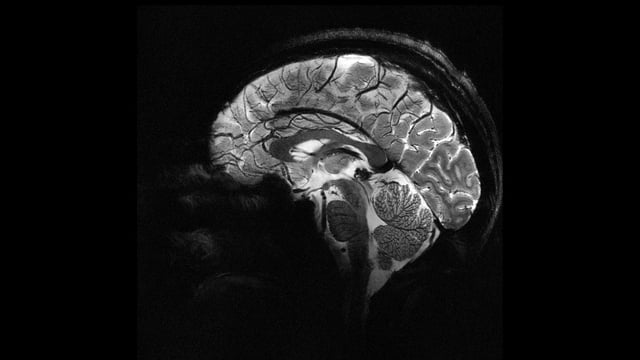 Can zapping your brain with electricity improve math skills? Yes