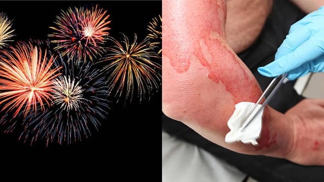 The Most Common Injuries On 4th of July, acc to an ER Doctor