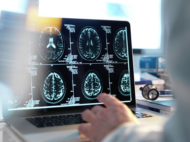 New research from Stanford scientists found that an “extremely aged” brain was associated not only with an increased risk of developing Alzheimer’s disease, but a 182% increased risk of dying in the next 15 years.