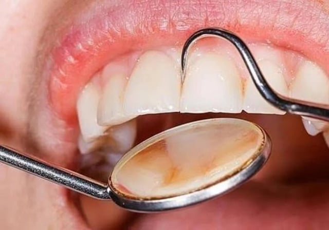 Los expertos confirman que una buena salud bucal es esencial para prevenir el cáncer