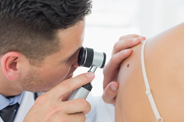 Stock image of a doctor inspecting a patient&#39;s mole for skin cancer,
