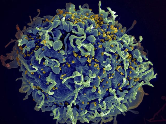 FILE - This colorized electron microscope image provided by the U.S. National Institutes of Health shows a human T cell, in blue, under attack by HIV, in yellow, the virus that causes AIDS. 