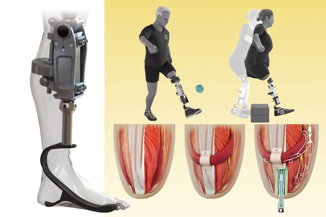 The new bionic knee can help people with above-the-knee amputations walk faster, climb stairs, and avoid obstacles more easily than they could with a traditional prosthesis. The new system is directly integrated with the user’s muscle and bone tissue (bottom row right). This enables greater stability and gives the user much more control over the movement of the prosthesis.