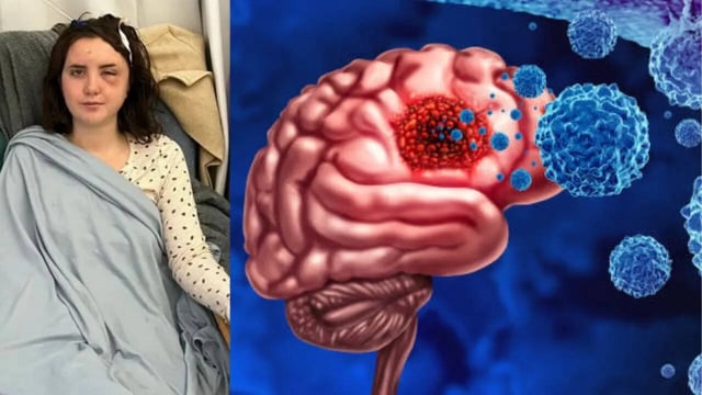 Woman's Symptoms of Heatstroke Turned Out to Be a Deadly Cancer; How to Spot Signs of a Brain Tumour