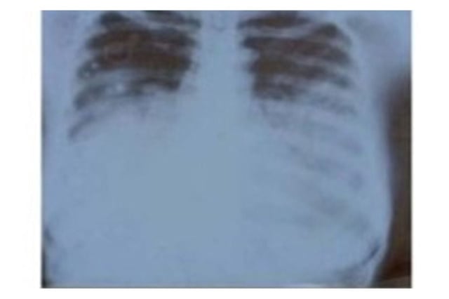 Muere residente en Arizona por peste neumónica. | Crédito: Centers for Disease Control and Prevention