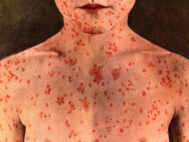 The province reported Monday that it has seen 1,314 cases since the beginning of March.