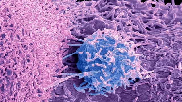 The revolution in cancer treatment involves an increasingly bespoke approach