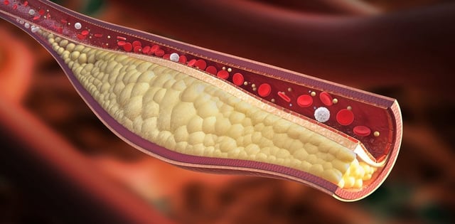 La ateroesclerosis puede provocar infarto de miocardio, ACV o insuficiencia circulatoria.