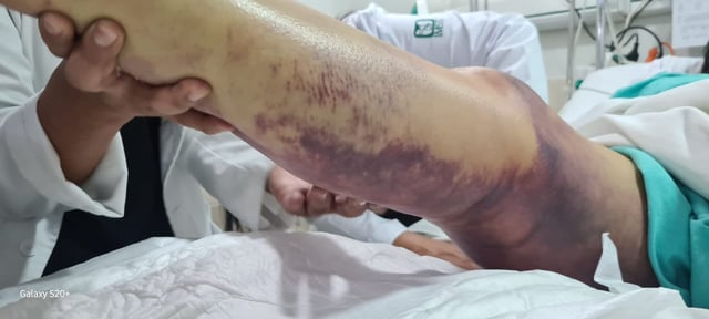 La joven Adriana, sufrió una mordedura de víbora, y logró sobrevivir, gracias a la atención recibido en la Unidad Médica de Alta Especialidad (UMAE), &#34;Dr. Gaudencio González&#34;, en La Raza